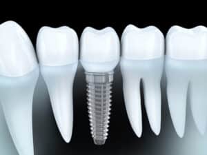 dental implants cost