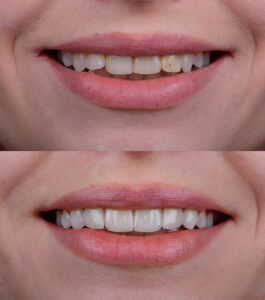 how do veneers work
